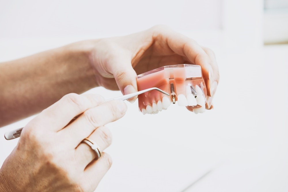 Ką reikia žinoti prieš atliekant dantų protezavimą